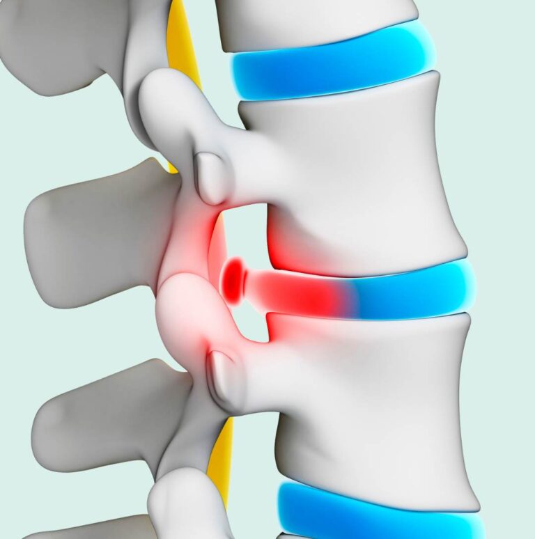 Hernia de disco