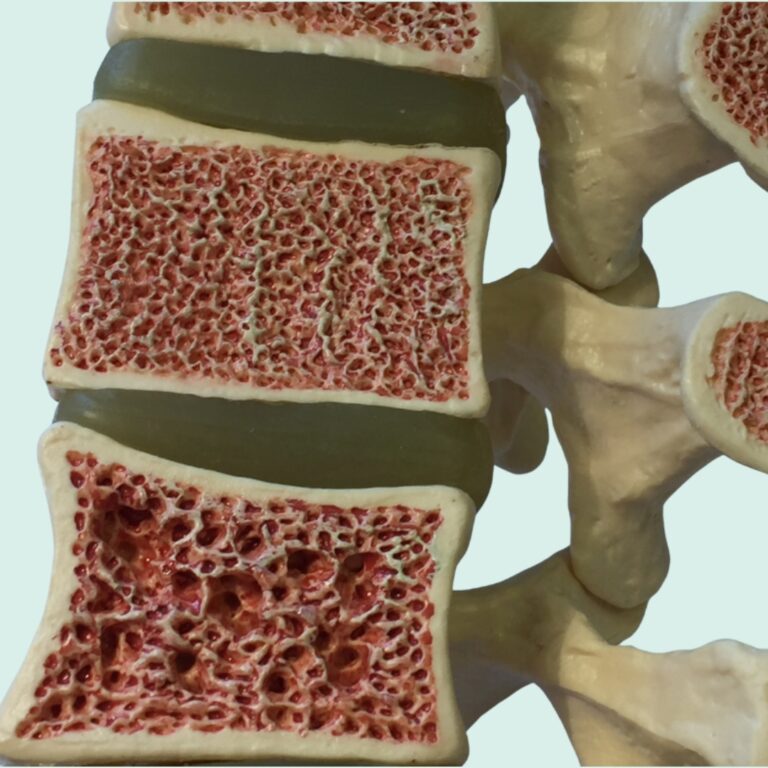 osteoporosis